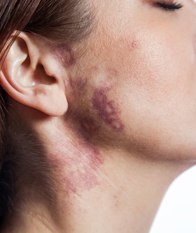 Port wine stain on woman's face and neck