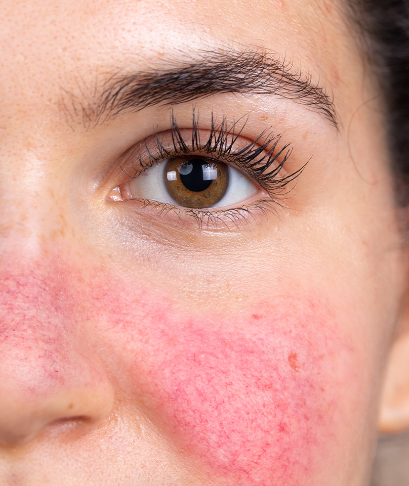 Rosacea on woman's face