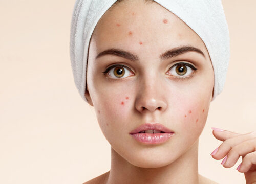 Photo of a woman with acne on her face