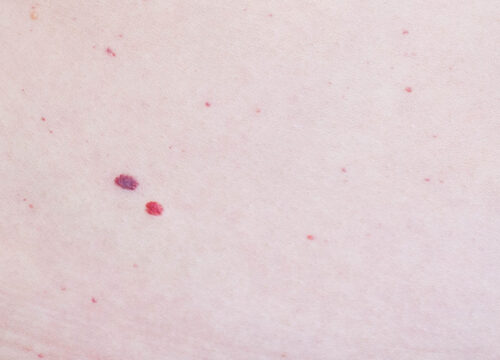 Photo of hemangiomas on a person's skin