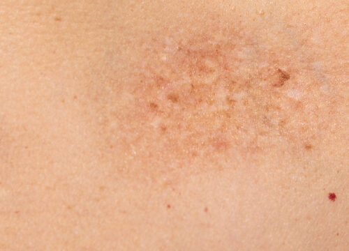Photo of a port wine stain on a person's skin