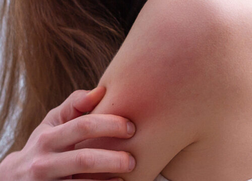 Photo of a psoriasis rash on a woman's shoulder