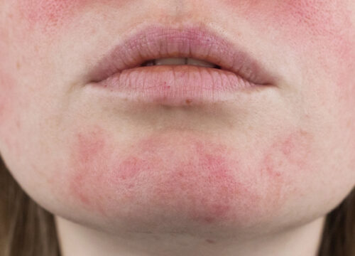 Photo of vascular lesions on a woman's chin and face