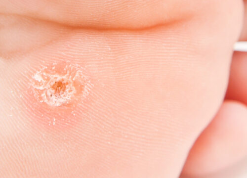 Photo of a wart on a man's foot